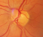 Normal Optic Nerve