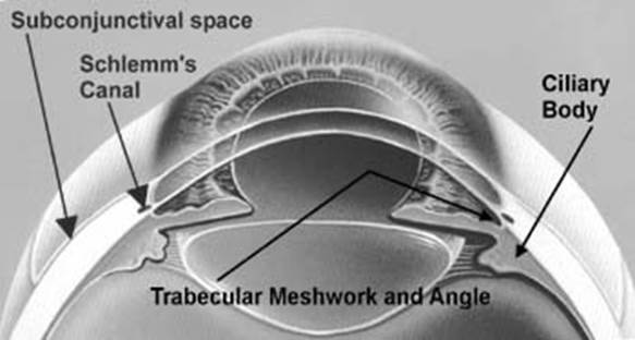 Glaucoma