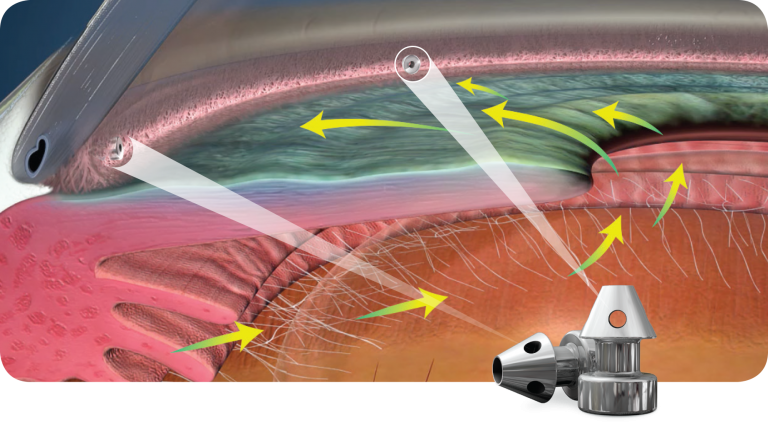 IStent – West Metro Ophthalmology MN